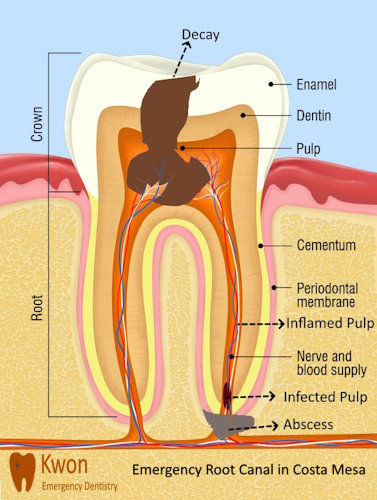 Emergency Root Canal in Costa Mesa